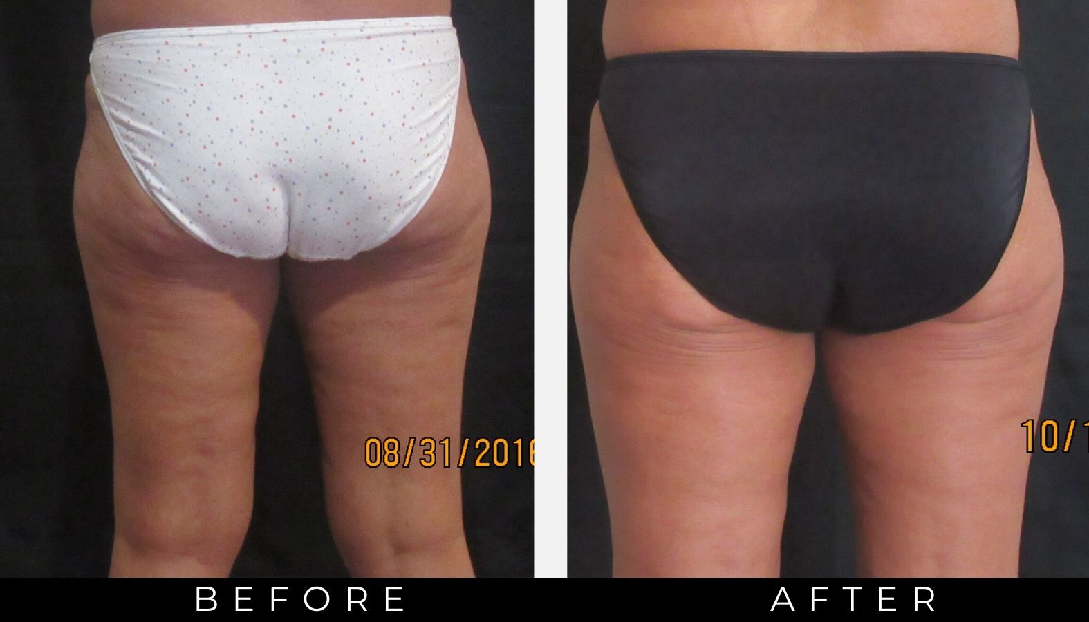 Cellulite removal with Cellutone Glow Coastal