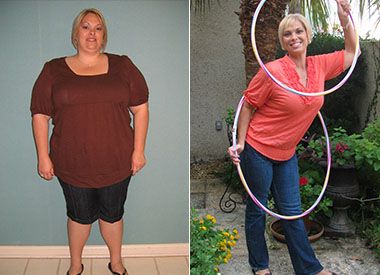 Jennifer's Before and after weight loss surgery