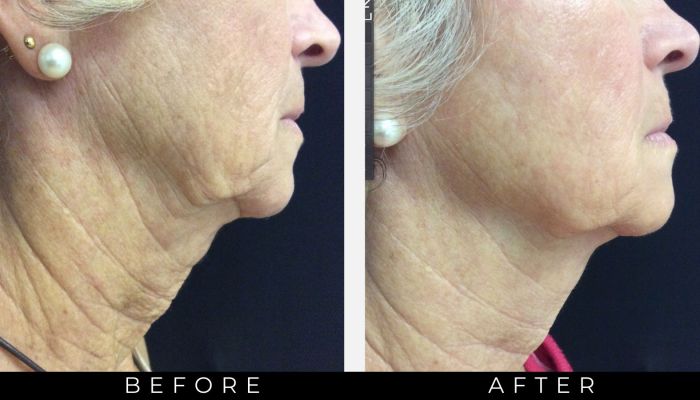 Exilis Ultra results on frontal view lower face and neck