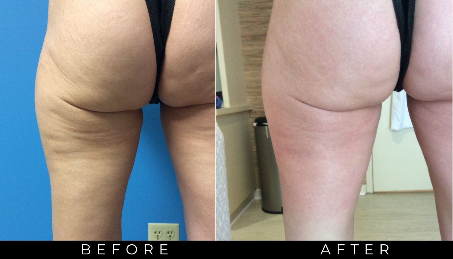 cellutone cellulite procedure on but and thighs