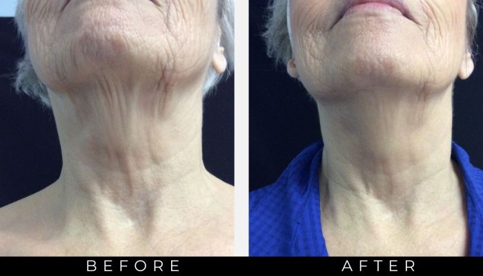 Exilis Ultra results on frontal view lower face and neck
