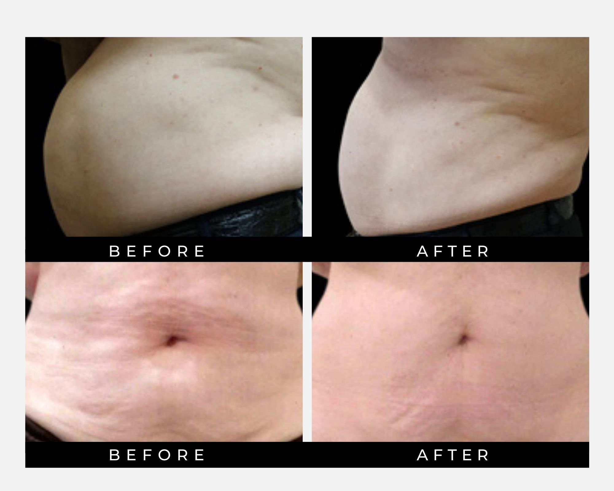 Vanquish ME Results Stomach