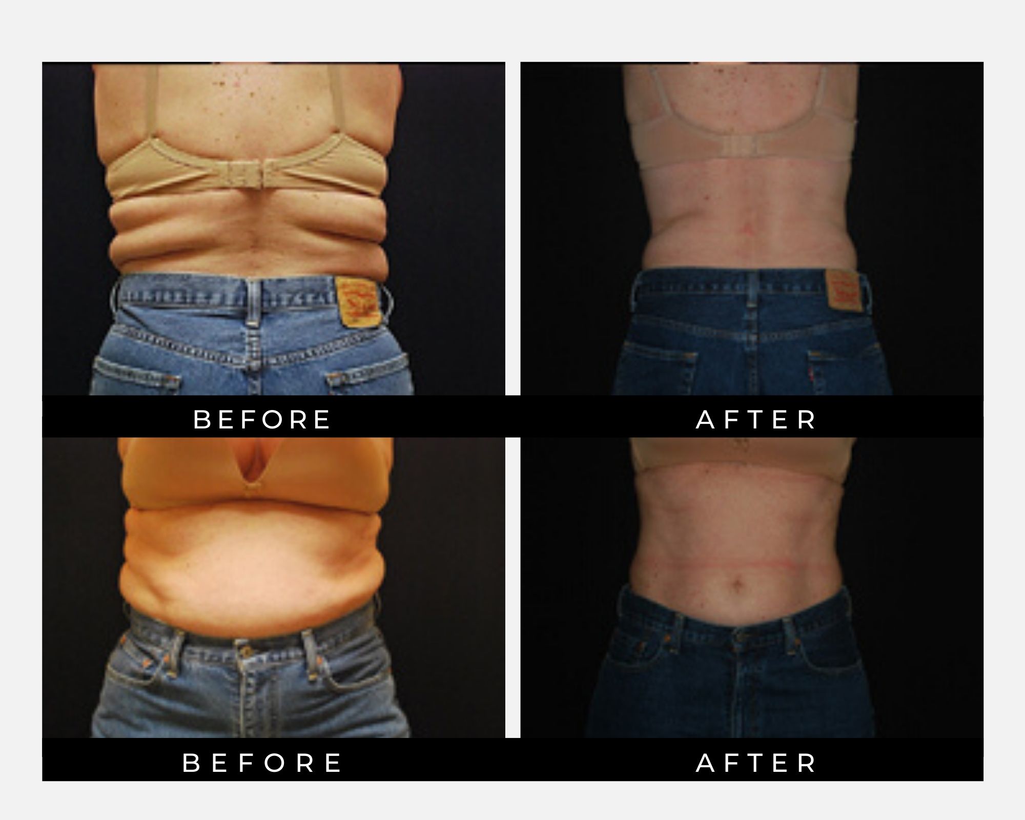 VANquish ME Results Back flaps and love handles