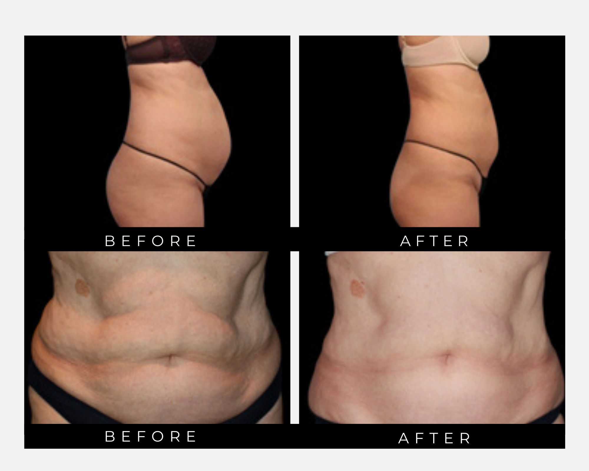 Vanquish ME Results stomach rolls