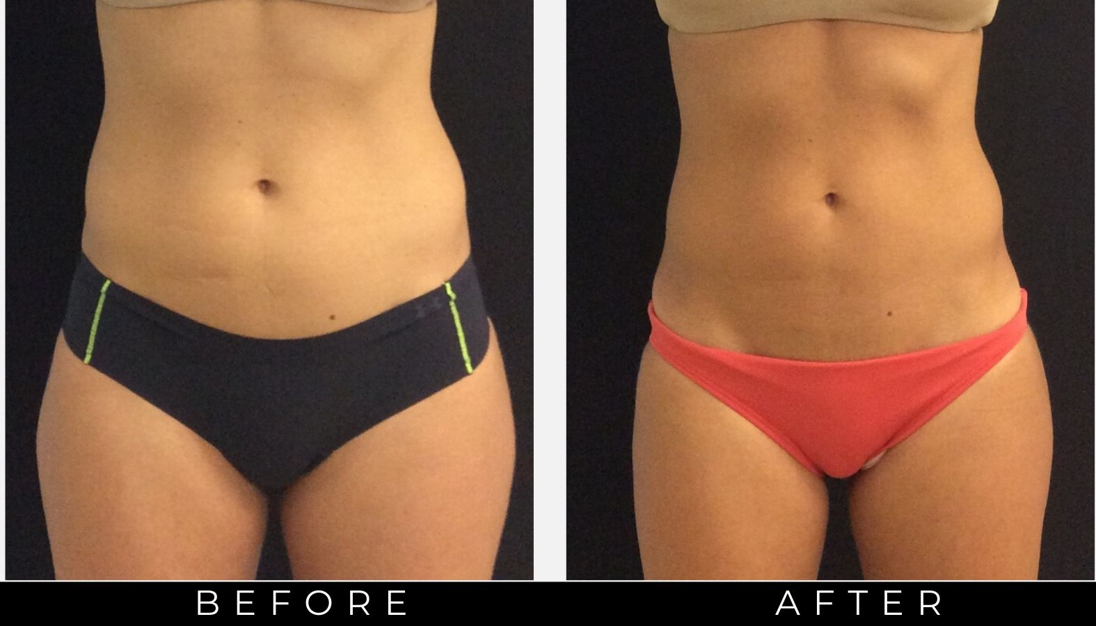 love handle removal with cool sculpting