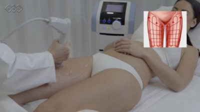 BTL Cellutone treatment  on legs