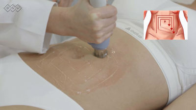 BTL Cellutone patient